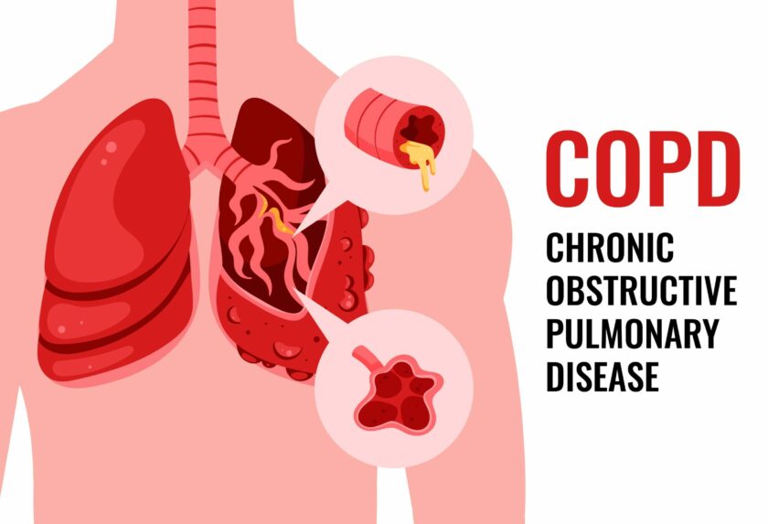 Coping with COPD: Rehabilitation & Care